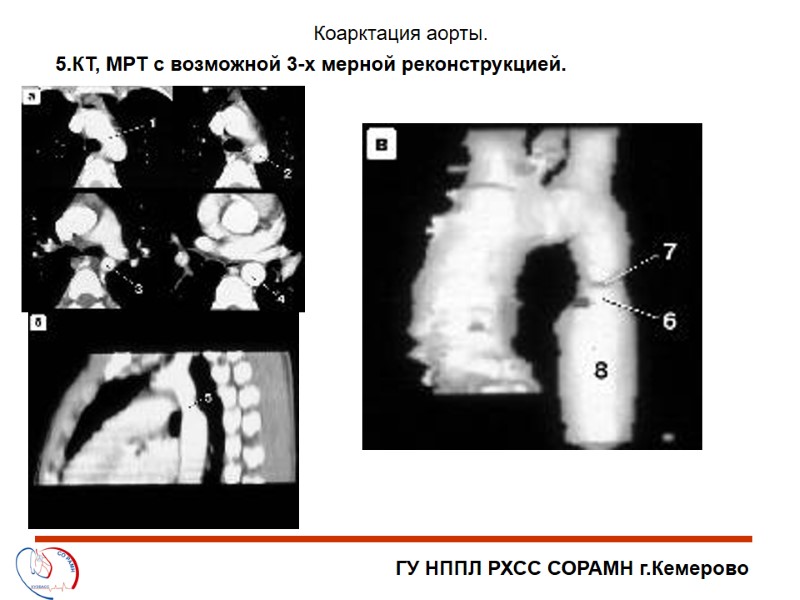 ГУ НППЛ РХСС СОРАМН г.Кемерово Коарктация аорты. 5.КТ, МРТ с возможной 3-х мерной реконструкцией.